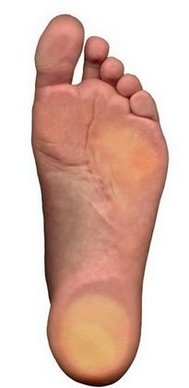 McMurray Podiatrist | McMurray Flatfoot (Fallen Arches) | PA | Pittsburgh Family Foot Care, P.C. |