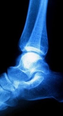 McMurray Podiatrist | McMurray Haglund's Deformity | PA | Pittsburgh Family Foot Care, P.C. |
