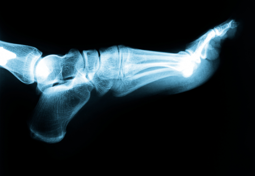 McMurray Podiatrist | McMurray Plantar Fasciitis | PA | Pittsburgh Family Foot Care, P.C. |